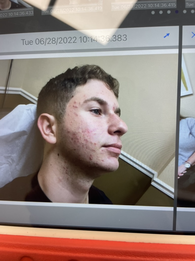 My Personal Before Picture before Accutane